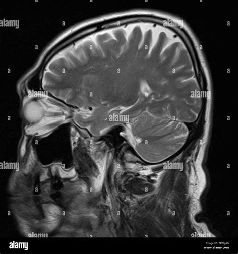 Healthy human brain, MRI scan Stock Photo - Alamy