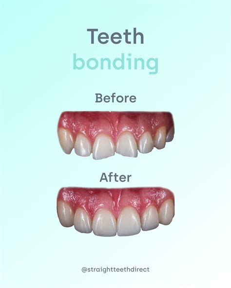 Is teeth bonding a good idea? What to do after aligner treatment