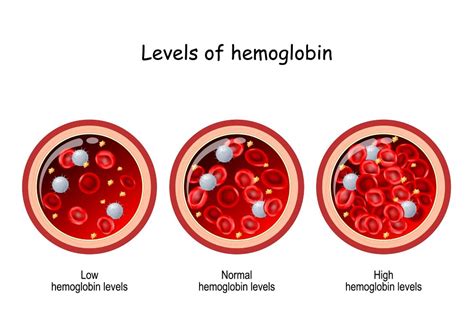 Hemoglobin Levels in Pregnant Women: Natural Ways to Up Your Platelet Count | Cloudnine Hospital