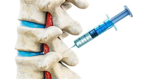 Facet Joint Injections: Everything You Need to Know - Spine Info