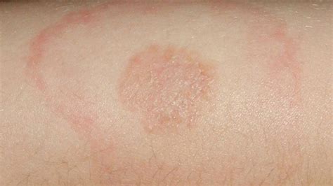 Erythema Migrans: Identification, Treatment, and More