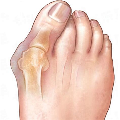 Bunion Pain Relief - Pain relief with these 4 devices