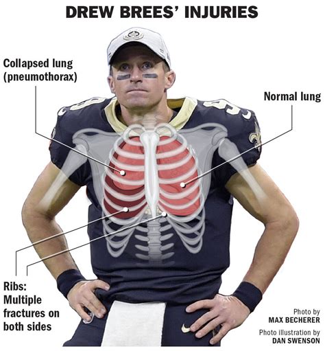 Drew Brees has missed 7 starts due to injury in 25 years. A review of ...