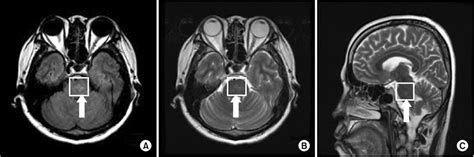 Brain magnetic resonance imaging (MRI) scan at the level of the pons ...