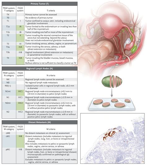 Uterine Cancer