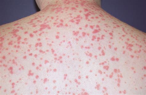 Psoriasis | Causes, Triggers, Diagnosis & Treatment