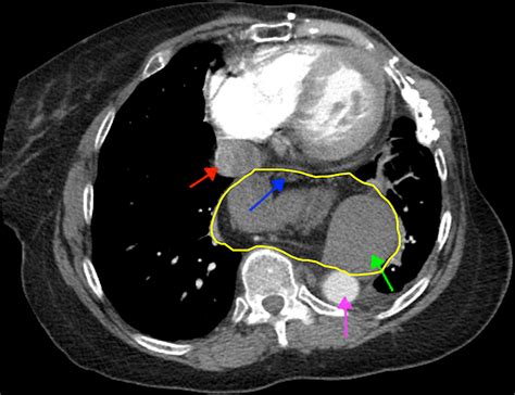 Cureus | Minding the Gap: Clinical Manifestations of a Rare Type IV Hiatal Hernia