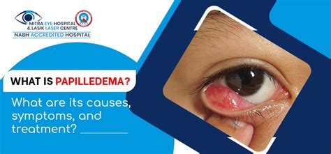 What is papilledema? What are its causes, symptoms, and treatment?