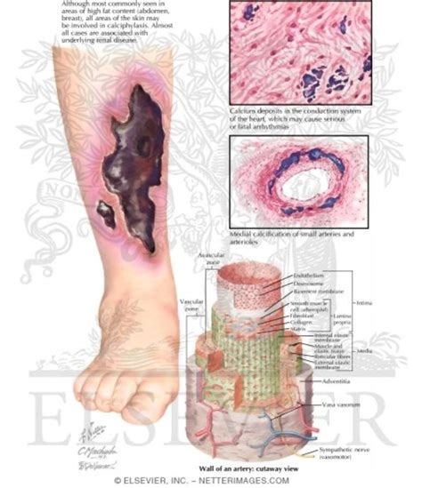 Early Calciphylaxis