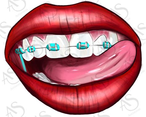 Dental Braces Clipart