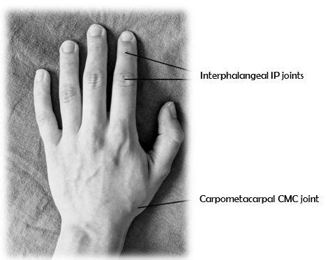 Osteoarthritis Hand | NHS Lanarkshire