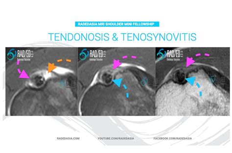 MRI BICEPS TENDON TENDONOSIS AND TENOSYNOVITIS - Radedasia