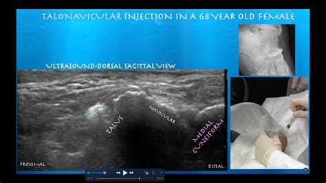 Ultrasound Guided Talonavicular Joint Cortisone Injection in a 68 Year Old Female - YouTube