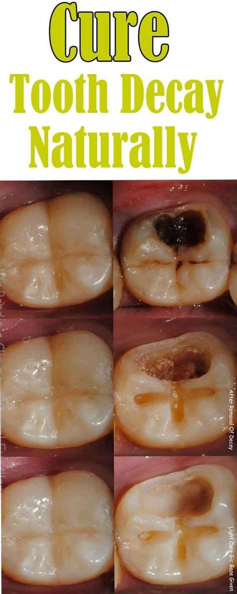 Here 5 Steps For Healing Your Tooth decay & Reverse Cavities at Home | Heal cavities, Dental ...