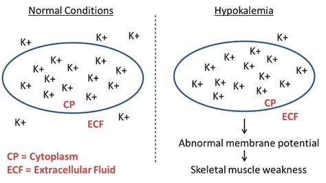 What Is Hypokalemia? - Definition, Causes, Symptoms & Treatment | Study.com