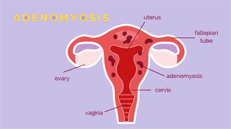 Adenomyosis: New 3 Symptoms, Causes And Risk Factors