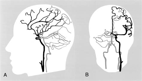 Collateral Circulation | Stroke