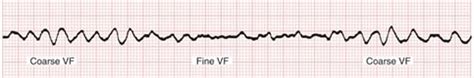 Shockable Rhythms | ACLS.com