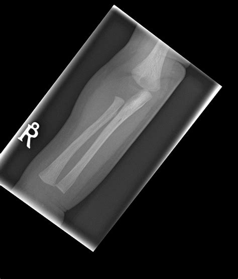 Metaphyseal corner fracture | Image | Radiopaedia.org