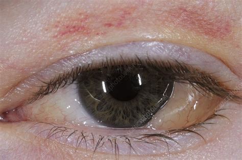 Swelling (chemosis) of the conjunctiva - Stock Image C011/7531 - Science Photo Library