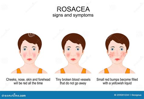 Rosacea. Signs And Symptoms Of Skin Cosmetic Problems Vector Illustration | CartoonDealer.com ...