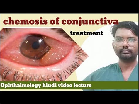 chemosis of conjunctiva / conjunctiva of chemosis / chemosis disease ...