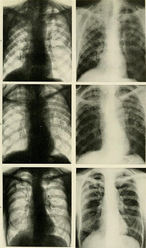 Chest congestion treatment | General center | SteadyHealth.com