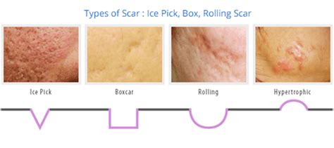 » Acne and Acne Scarring