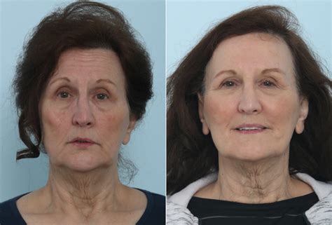 Juvederm Injectable Gel Photos | Houston, Tx | Patient 9453