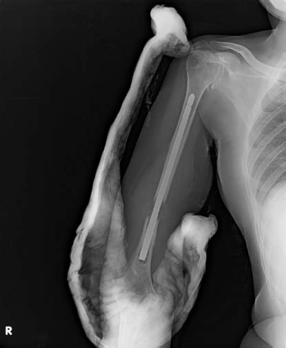 X-ray Humerus showing the fracture | Download Scientific Diagram