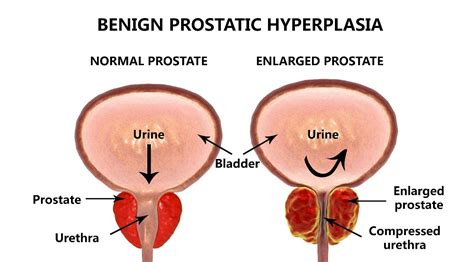 Benign Prostatic Hyperplasia Melbourne | North Eastern Urology