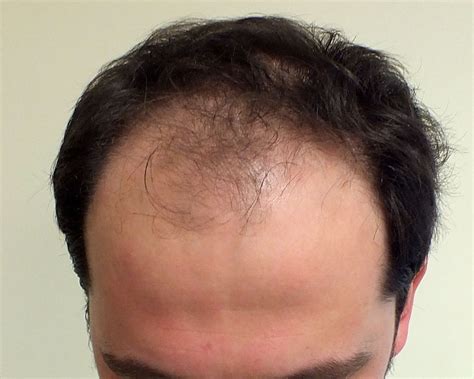 Civas Hair Transplant Before After panosundaki Pin