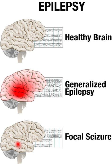 Epilepsy - A Neurological Disorder... What triggers an epileptic seizure? Wanna know more?? 👇👇 ...