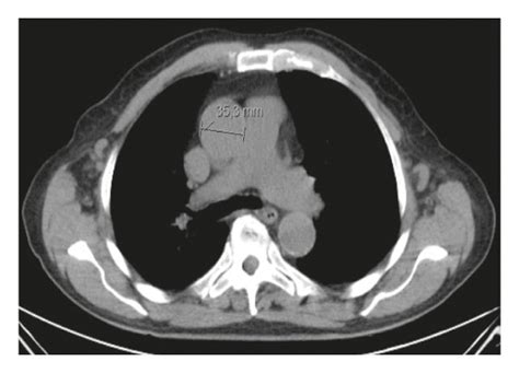 (a) CT scan showing mediastinal lymphadenopathy measuring 35.3 mm ...