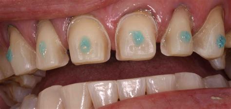 Cementing Veneer Provisionals - Lee Ann Brady DMD