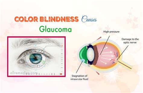 List Of 13 Common Color Blindness Causes, Symptoms, And Effects