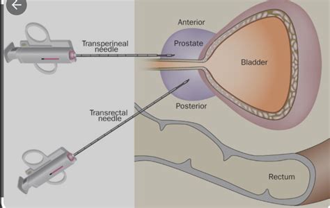 Transperineal Biopsy - prostate cancer - Gulfsouth