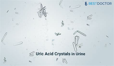 Uric Acid Crystals In Urine - Causes, Symptoms, Prevention, Treatment