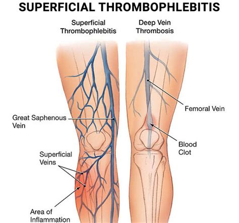 Superficial Thrombophlebitis Treatment in NYC & NJ | Vein Care Center