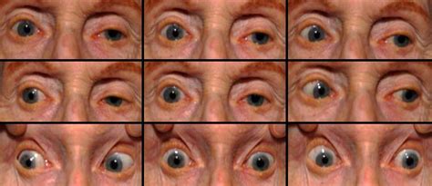 Progressive Supranuclear Palsy in a Patient with Progressive Nonfluent Aphasia. Ophthalmology ...