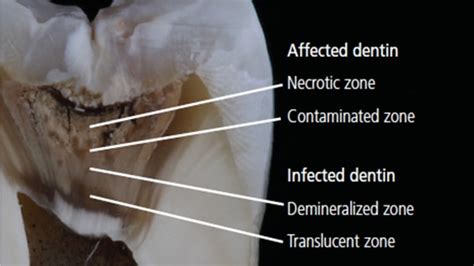 Clinical Treatment of Deep Caries - Decisions in Dentistry