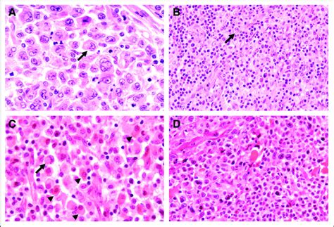 (A) Anaplastic large-cell lymphoma (ALCL), common variant. Predominant... | Download Scientific ...