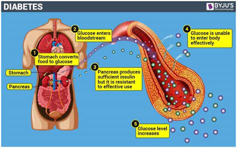 Diabetes Mellitus Type 1 Gland Affected - DiabetesWalls