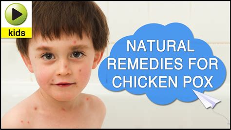 Kids Health: Chicken Pox - Natural Home Remedies for Chicken Pox - YouTube