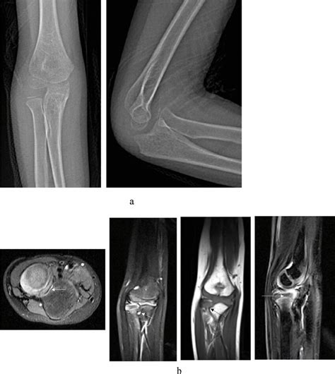 Imaging of a 7 years old boy (case 2) referred for the treatment of... | Download Scientific Diagram