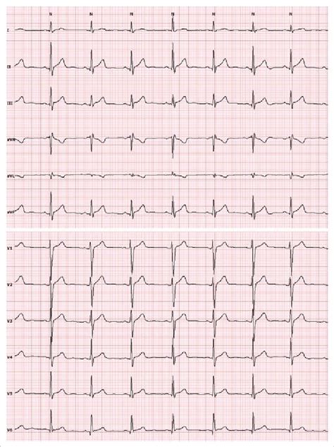 Electrocardiogram recorded after normalisation of hyperthyroidism | Download Scientific Diagram