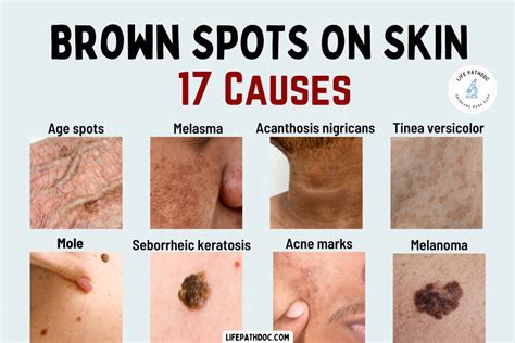 Brown Spots on Skin: 17 Causes, Pictures, Treatment