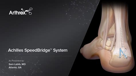 Arthrex - Achilles SpeedBridge™ System