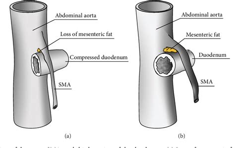 Figure 1 from Superior Mesenteric Artery Syndrome Associated with Rapid Weight Loss Attributed ...