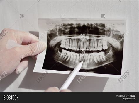 Dental X-ray Braces. Image & Photo (Free Trial) | Bigstock